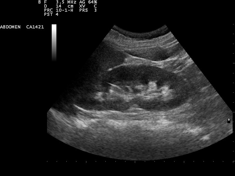 Ultrasound image of a human kidney, from a public medical image library