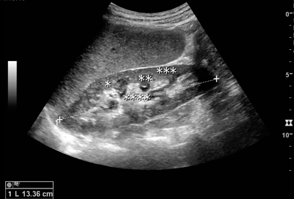 Ultrasound of a normal adult kidney with labelled anatomy, from a published teaching review