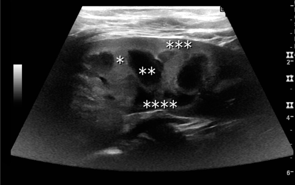 Ultrasound of a normal child's kidney with labelled anatomy, from a published teaching review